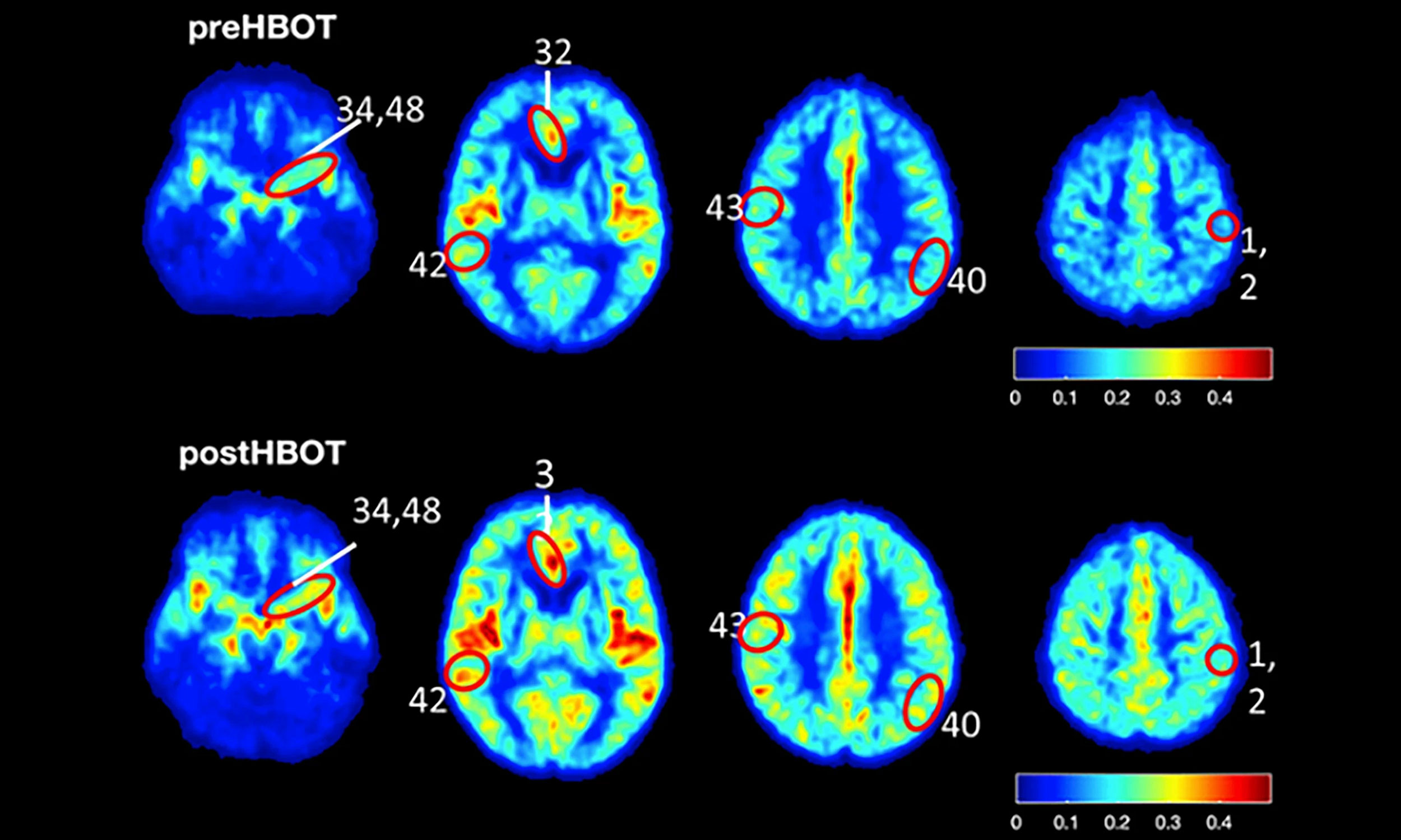 img blog brightside oxygen therapy could treat alzheimers